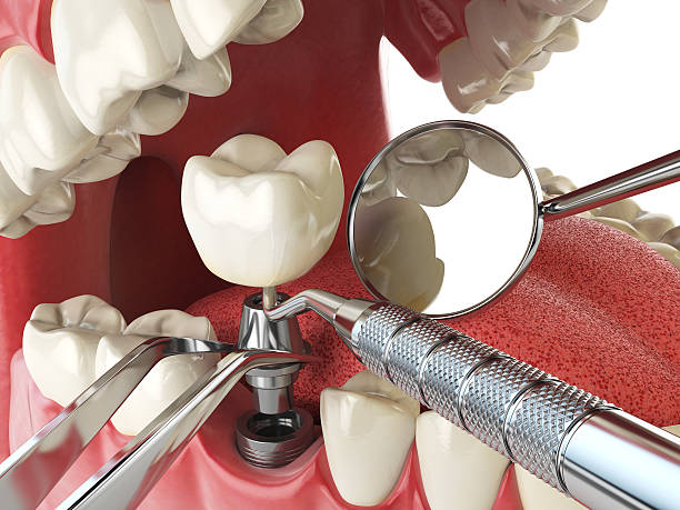 Best Emergency Root Canal Treatment in Atherton, CA